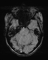 Cerebral cavernous venous malformation (Radiopaedia 70008-80021 I 22).jpg
