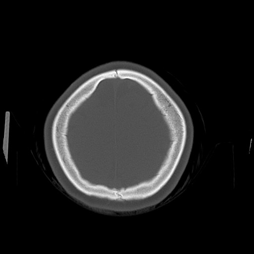 File:Cerebral cavernous venous malformation (Radiopaedia 70008-80022 Axial bone window 48).jpg