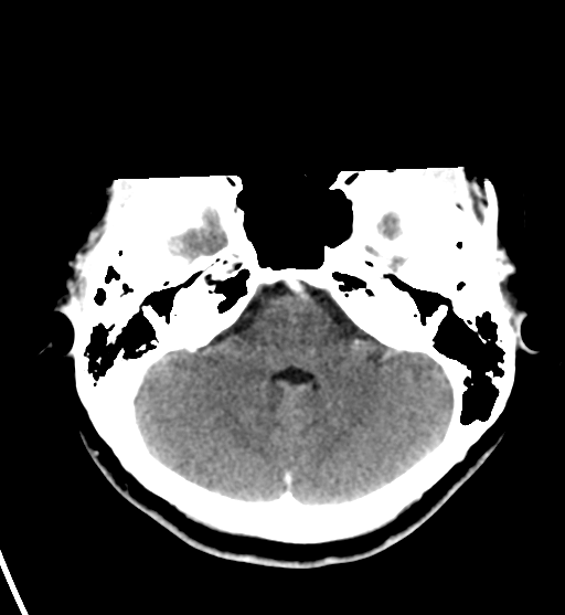 File:Cerebral cavernous venous malformations (Radiopaedia 48117-52945 Axial C+ delayed 10).png