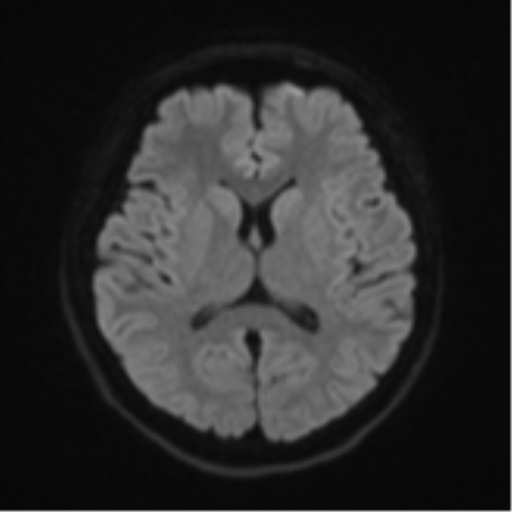 Cerebral cavernous venous malformations (Radiopaedia 48117-52946 Axial DWI 43).png