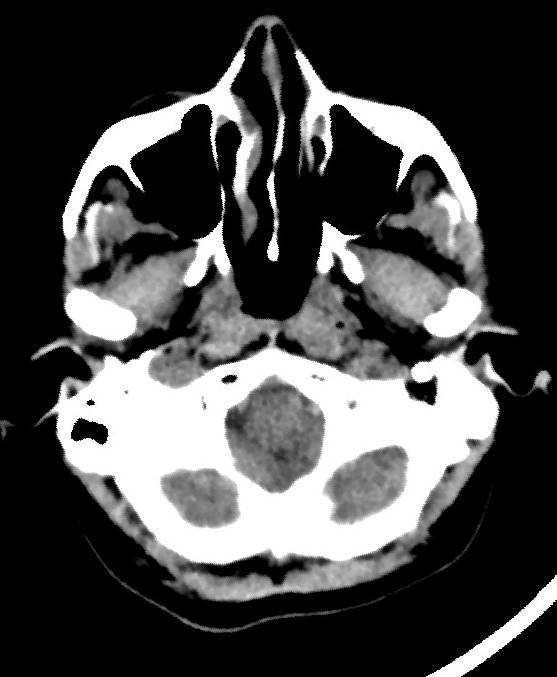 Cerebral edema due to severe hyponatremia (Radiopaedia 89826-106937 Axial non-contrast 10).jpg
