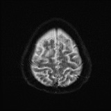 Cerebral embolic infarcts (embolic shower) (Radiopaedia 72391-82921 Axial DWI 26).jpg