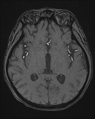 Cerebral embolic infarcts (embolic shower) (Radiopaedia 72391-82921 Axial MRA 88).jpg