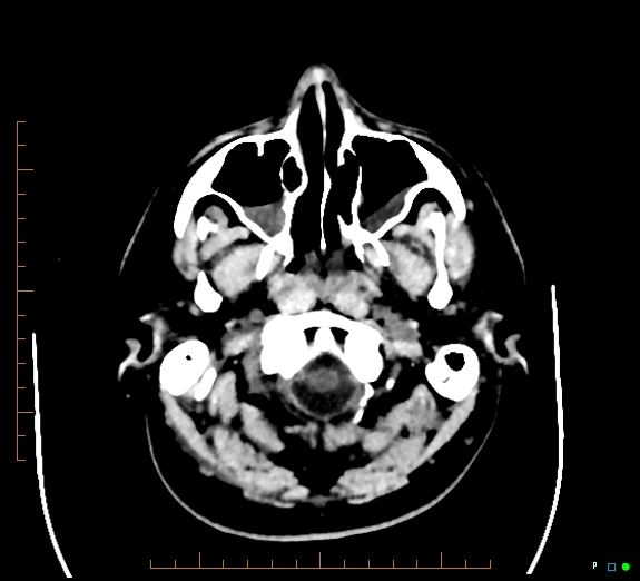 Cerebral fat embolism (Radiopaedia 85521-101220 Axial non-contrast 11).jpg