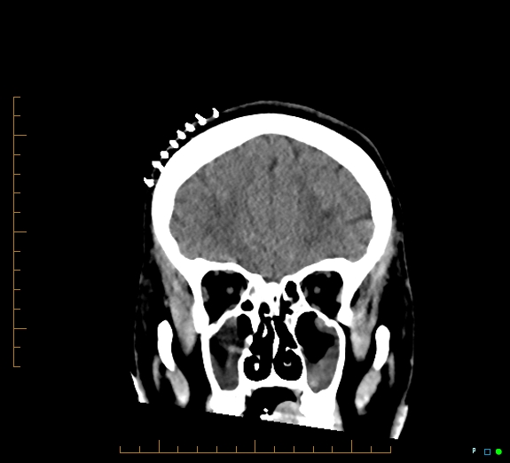 Cerebral fat embolism (Radiopaedia 85521-101220 Coronal non-contrast 17).jpg