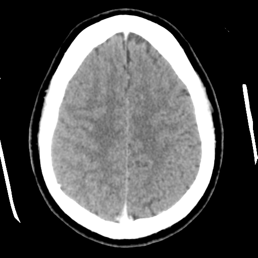 File:Cerebral hemorrhage secondary to arteriovenous malformation (Radiopaedia 33497-34561 B 41).png