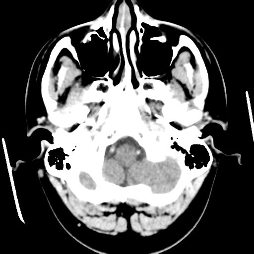 Cerebral hemorrhage secondary to arteriovenous malformation (Radiopaedia 33497-34561 B 9).png