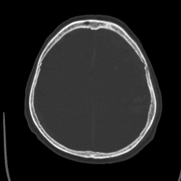 Cerebral hemorrhagic contusions (Radiopaedia 23145-23188 Axial bone window 41).jpg