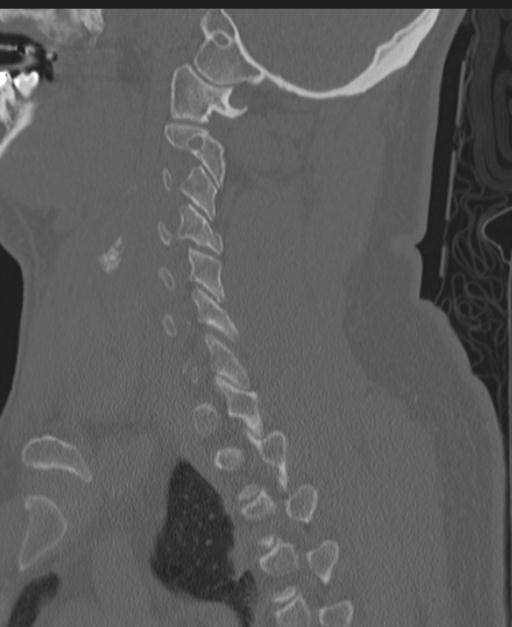Cerebral hemorrhagic contusions and cervical spine fractures (Radiopaedia 32865-33841 Sagittal bone window 65).jpg