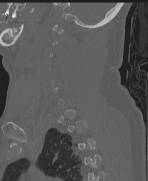 Cerebral hemorrhagic contusions and cervical spine fractures (Radiopaedia 32865-33841 Sagittal bone window 72).jpg