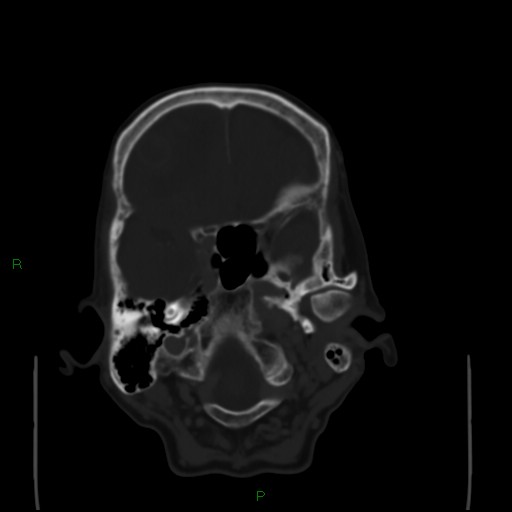 Cerebral metastases - breast primary (Radiopaedia 77653-89857 Axial bone window 25).jpg