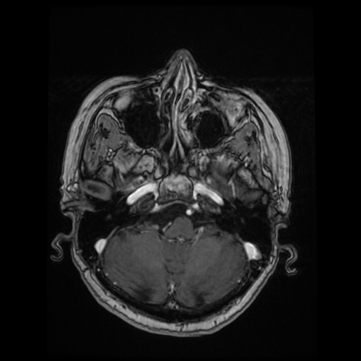 Cerebral metastases - melanoma (Radiopaedia 80972-94522 Axial T1 C+ 34).jpg