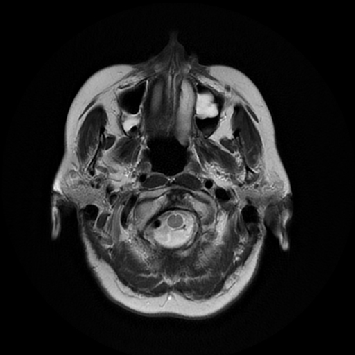 File:Cerebral metastases - melanoma (Radiopaedia 80972-94522 Axial T2 3).jpg