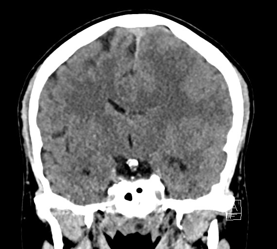 Cerebral metastases - testicular choriocarcinoma (Radiopaedia 84486-99855 Coronal C+ delayed 31).jpg