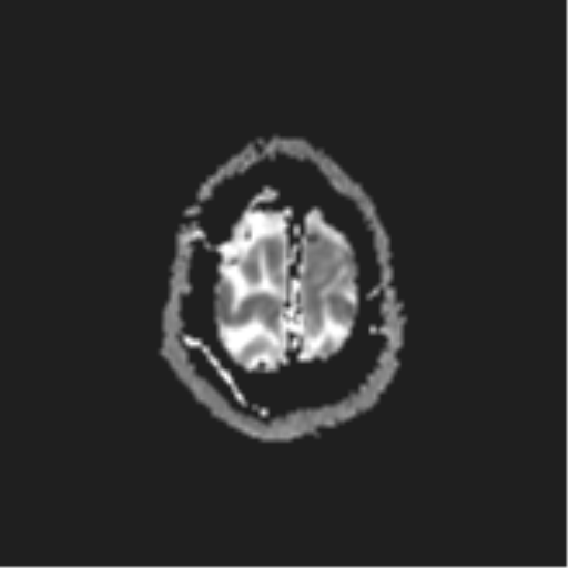 File:Cerebral metastases mimicking abscesses (Radiopaedia 45841-50131 Axial ADC 27).png
