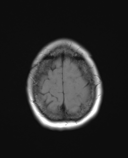File:Cerebral metastasis (Radiopaedia 46744-51248 Axial T1 25).png