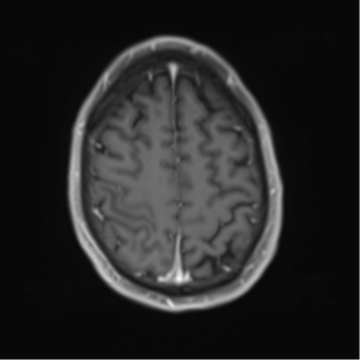 Cerebral metastasis - melanoma (Radiopaedia 54718-60954 Axial T1 C+ fat sat 43).png