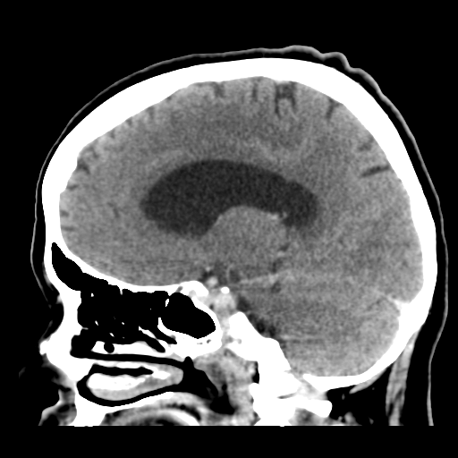 File:Cerebral metastasis to basal ganglia (Radiopaedia 81568-95412 Sagittal C+ delayed 34).png