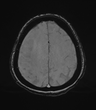 Cerebral metastasis to basal ganglia (Radiopaedia 81568-95413 Axial SWI magnitude 68).png