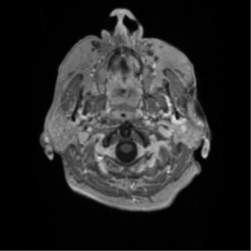 Cerebral metastasis to basal ganglia (Radiopaedia 81568-95413 Axial T1 C+ 1).png