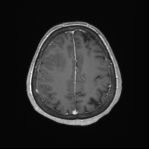 Cerebral metastasis to basal ganglia (Radiopaedia 81568-95413 Axial T1 C+ 57).png