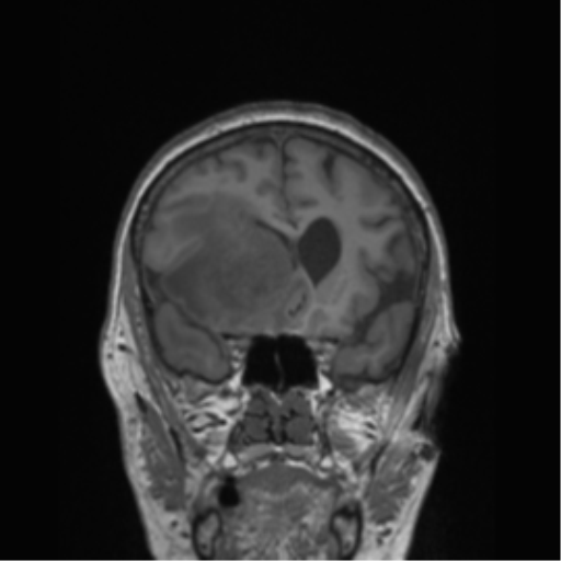 Cerebral metastasis to basal ganglia (Radiopaedia 81568-95413 Coronal T1 42).png