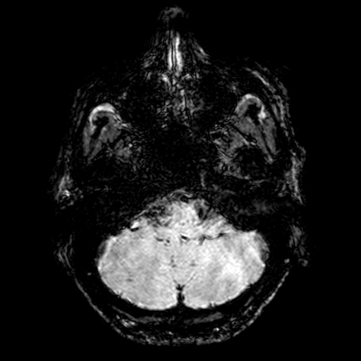 Cerebral parenchymal arteriovenous malformation (Radiopaedia 27280-27456 Axial SWI 10).jpg