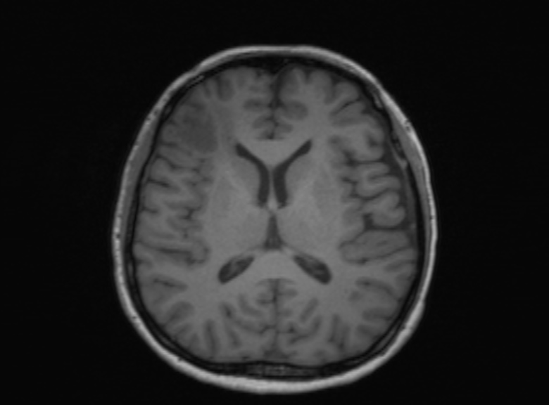 Cerebral ring enhancing lesions - cerebral metastases (Radiopaedia 44922-48817 Axial T1 211).jpg
