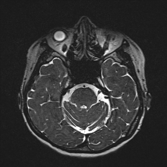 Cerebral ring enhancing lesions - cerebral metastases (Radiopaedia 44922-48817 F 51).jpg