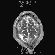 File:Cerebral toxoplasmosis (Radiopaedia 43956-47461 Axial ADC 18).jpg