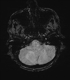 File:Cerebral toxoplasmosis (Radiopaedia 43956-47461 Axial SWI 6).jpg
