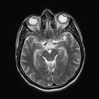 File:Cerebral toxoplasmosis (Radiopaedia 43956-47461 Axial T2 9).jpg