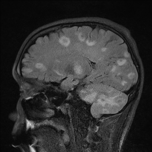 File:Cerebral toxoplasmosis (Radiopaedia 53993-60132 Sagittal FLAIR 11).jpg