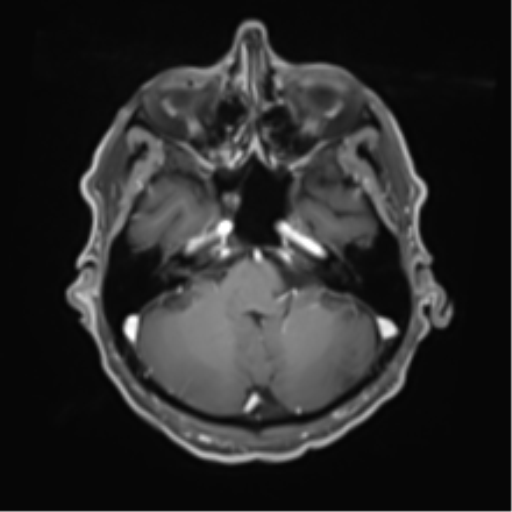 Cerebral toxoplasmosis (Radiopaedia 54575-60804 Axial T1 C+ 15).png