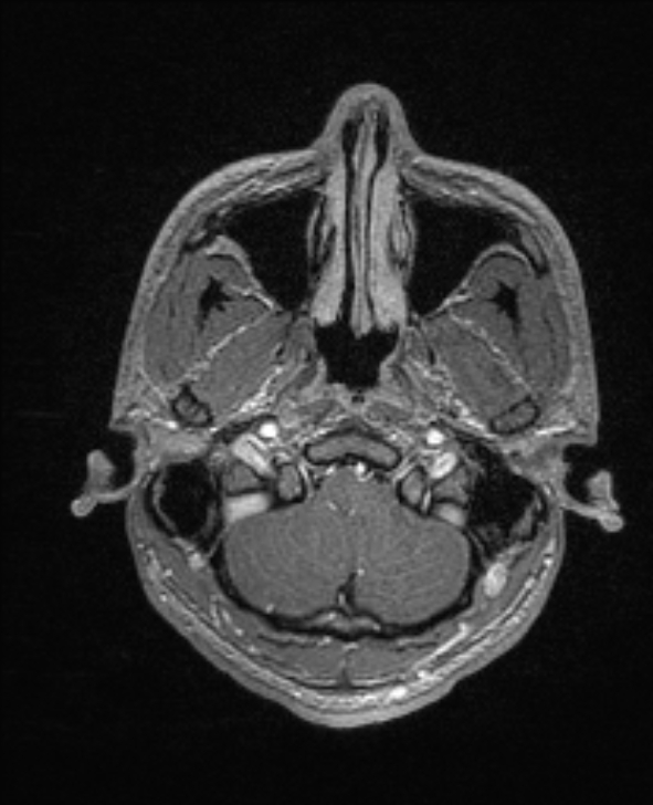 Cerebral toxoplasmosis (Radiopaedia 85779-101597 Axial T1 C+ 23).jpg