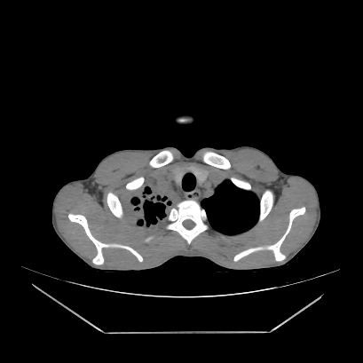 Cerebral tuberculoma (Radiopaedia 80829-94318 Axial non-contrast 3).jpg