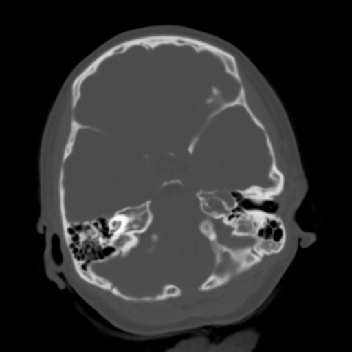 Cerebral tuberculosis with dural sinus invasion (Radiopaedia 60353-68018 Axial bone window 12).jpg
