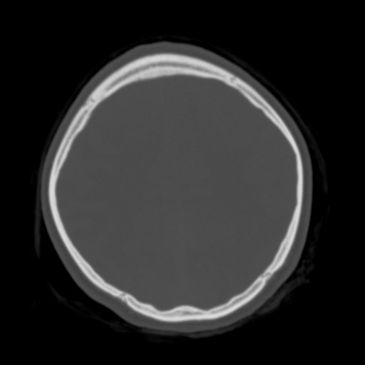 Cerebral tuberculosis with dural sinus invasion (Radiopaedia 60353-68018 Axial bone window 46).jpg