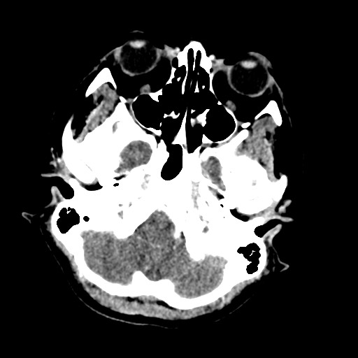 Cerebral tuberculosis with dural sinus invasion (Radiopaedia 60353-68019 Axial C+ delayed 10).jpg
