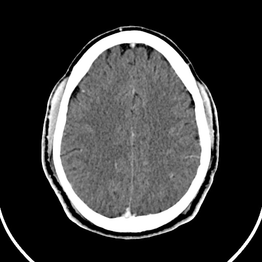 Cerebral venous angioma (Radiopaedia 69959-79977 B 70).jpg