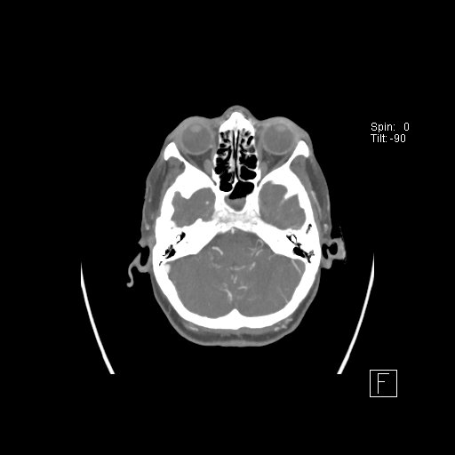 Cerebral venous infarction with hemorrhage (Radiopaedia 65343-74396 A 22).jpg