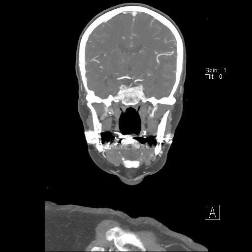 Cerebral venous infarction with hemorrhage (Radiopaedia 65343-74396 B 151).jpg