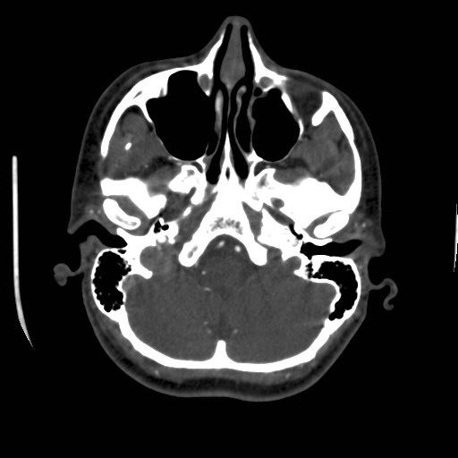 Cerebral venous sinus thrombosis (Radiopaedia 40619-43227 A 41).jpg