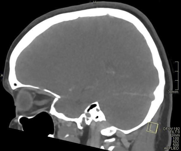 Cerebral venous sinus thrombosis (Radiopaedia 91329-108965 Sagittal venogram 27).jpg