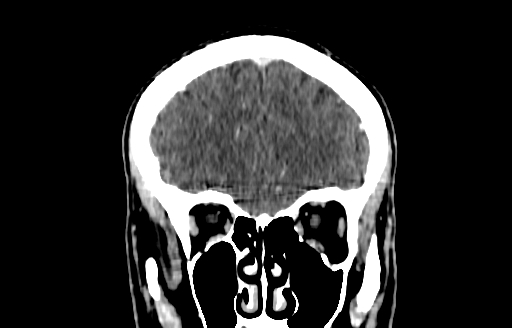 File:Cerebral venous thrombosis (CVT) (Radiopaedia 77524-89685 C 13).jpg