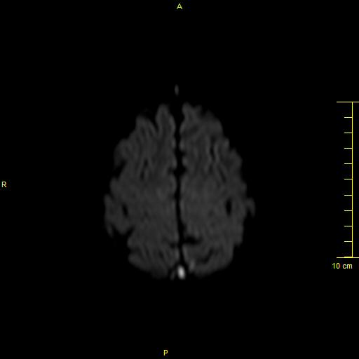 File:Cerebral venous thrombosis (Radiopaedia 23288-23351 Axial DWI 37).JPG