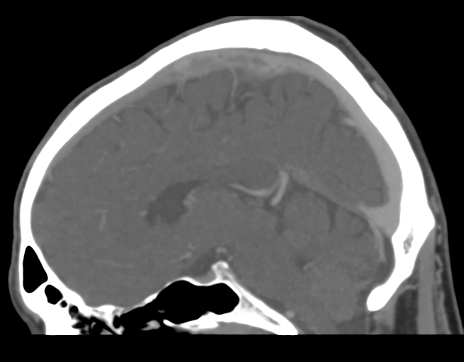 File:Cerebral venous thrombosis (Radiopaedia 38392-40467 D 28).png