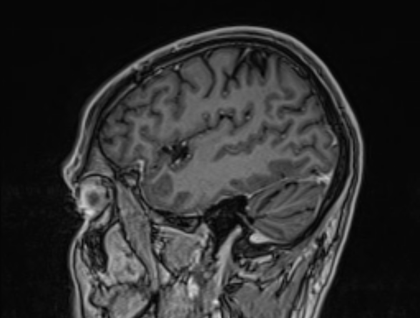 Cerebral venous thrombosis (Radiopaedia 71207-81504 Sagittal T1 C+ 11).jpg