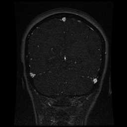 Cerebral venous thrombosis - ulcerative colitis (Radiopaedia 66049-75219 Coronal MRV 35).jpg