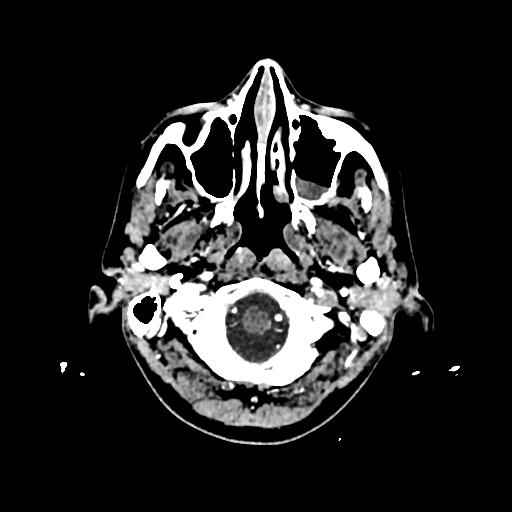 Cerebral venous thrombosis with venous hemorrhagic infarct (Radiopaedia 90354-107660 Axial with contrast 17).jpg